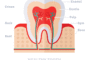 prevent enamel erosion feature