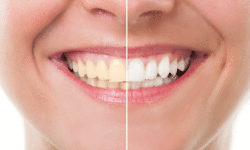 The Truth About Tooth Whitening