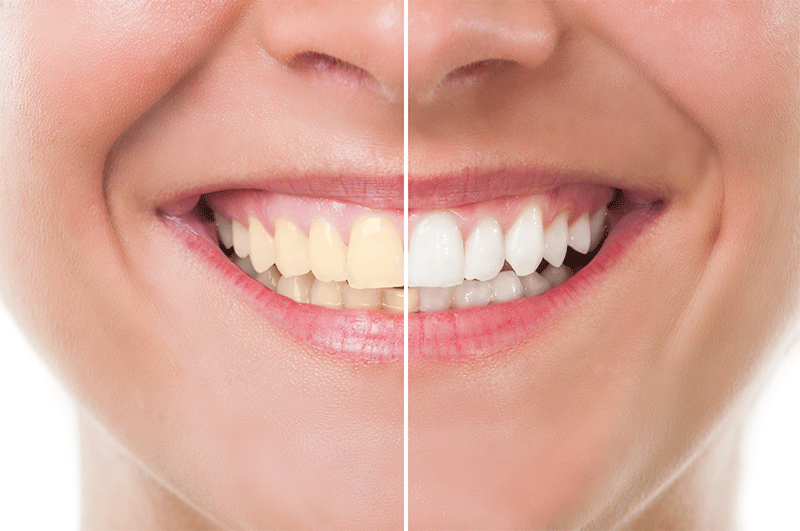 tooth whitening feature